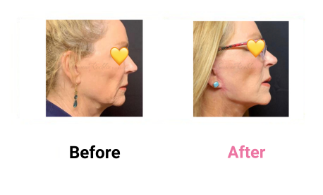 Short Scar Lower Neck & Face