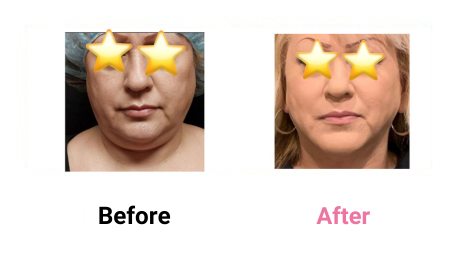 Liposuction Sculpting