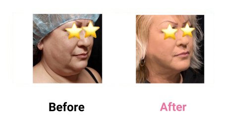 Liposuction Sculpting