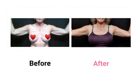 brachioplasty