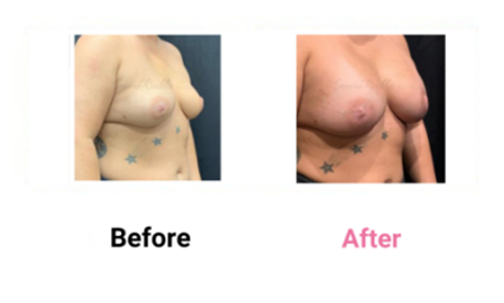 Breast Augmentation