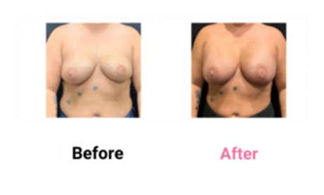 Breast Augmentation