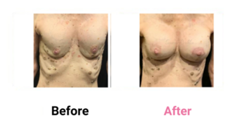 Mastopexy Implant Exchange