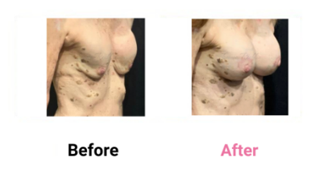 Mastopexy Implant Exchange