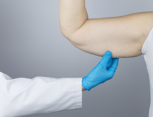 Dr. Rochlin’s Mastery in Arm Lift Surgery