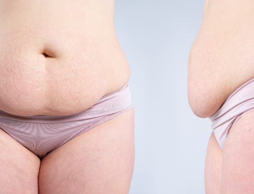Flaunting Fab Abs: Tummy Tuck Transformations