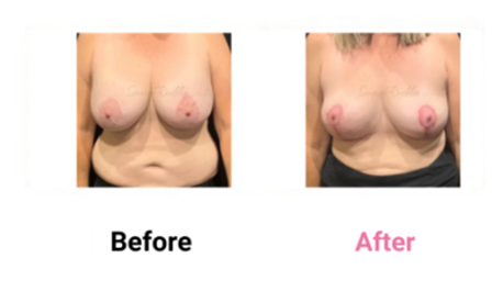 Mastopexy