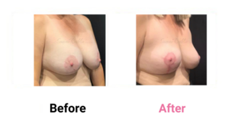 Mastopexy